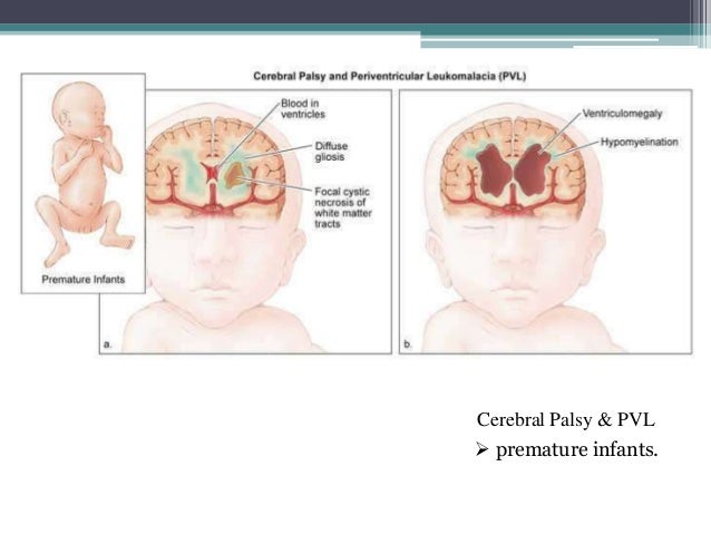 periventricular leukomalacia wiki periventricular leukomalacia grading